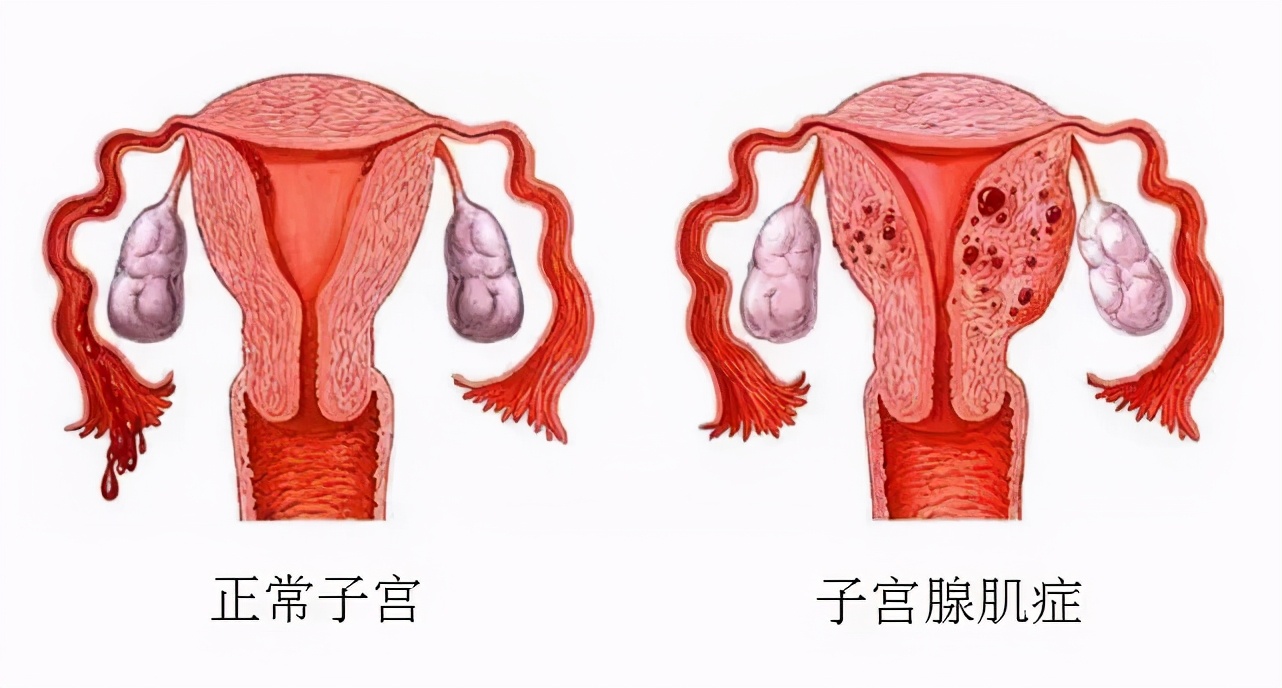 子宫腺肌症的痛苦经历,子宫腺肌症的姐妹如何面对痛苦