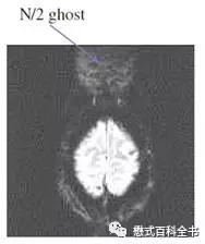 dwi成像序列,dwi序列和edwi序列