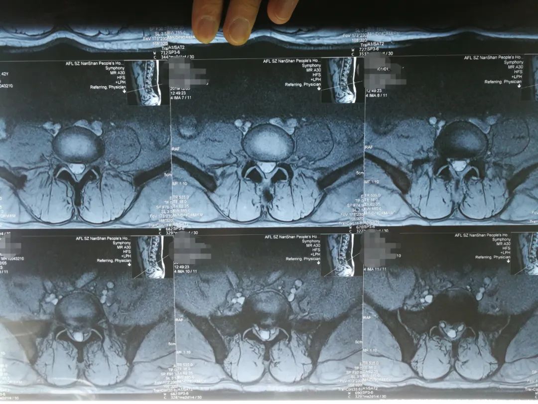 腰椎间盘突出症治疗,1个反射动作引出,提示治愈,医生很开心
