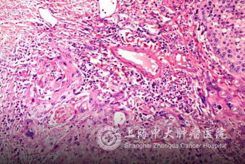 浸润癌术后需要治疗吗,浸润性腺癌手术后要化疗吗