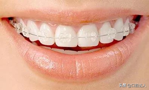 陶瓷半隐形牙套的优缺点,透明托槽和隐形牙套的区别
