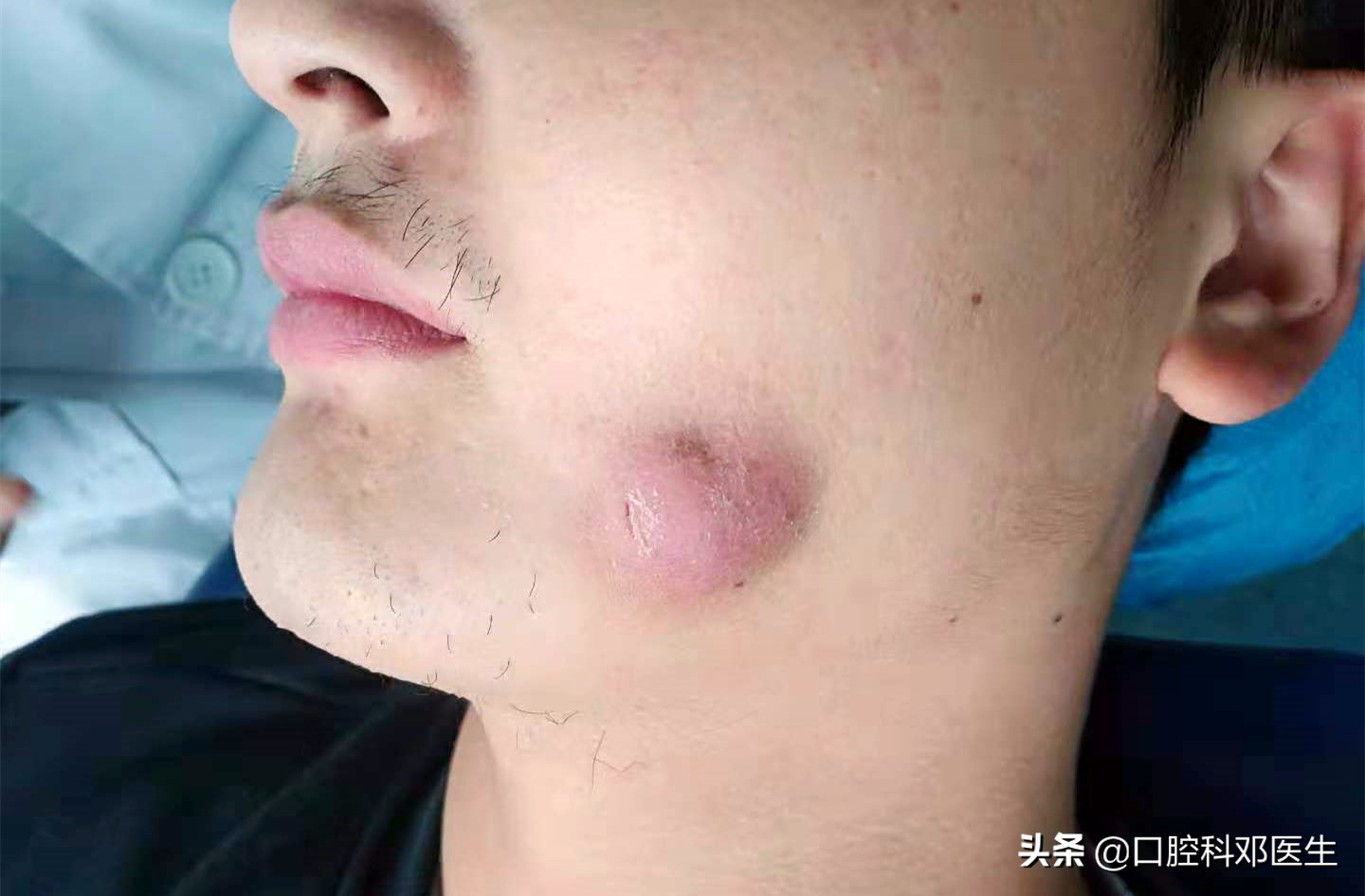 别让一颗牙齿毁了一张脸?医生说95%的人都有这样的牙齿!