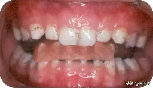 地包天早期矫正最佳时间,地包天最佳矫正时间及方法