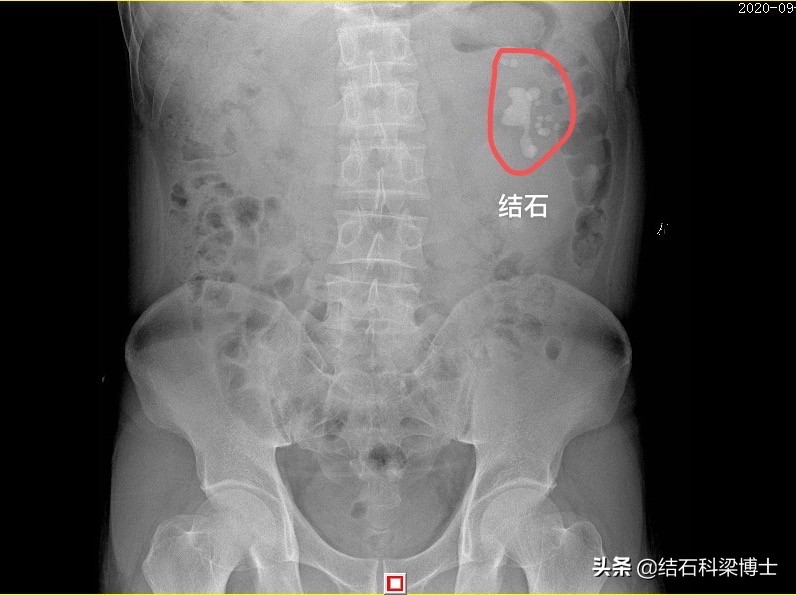 肾结石做手术致人死亡,江西赣州治肾结石