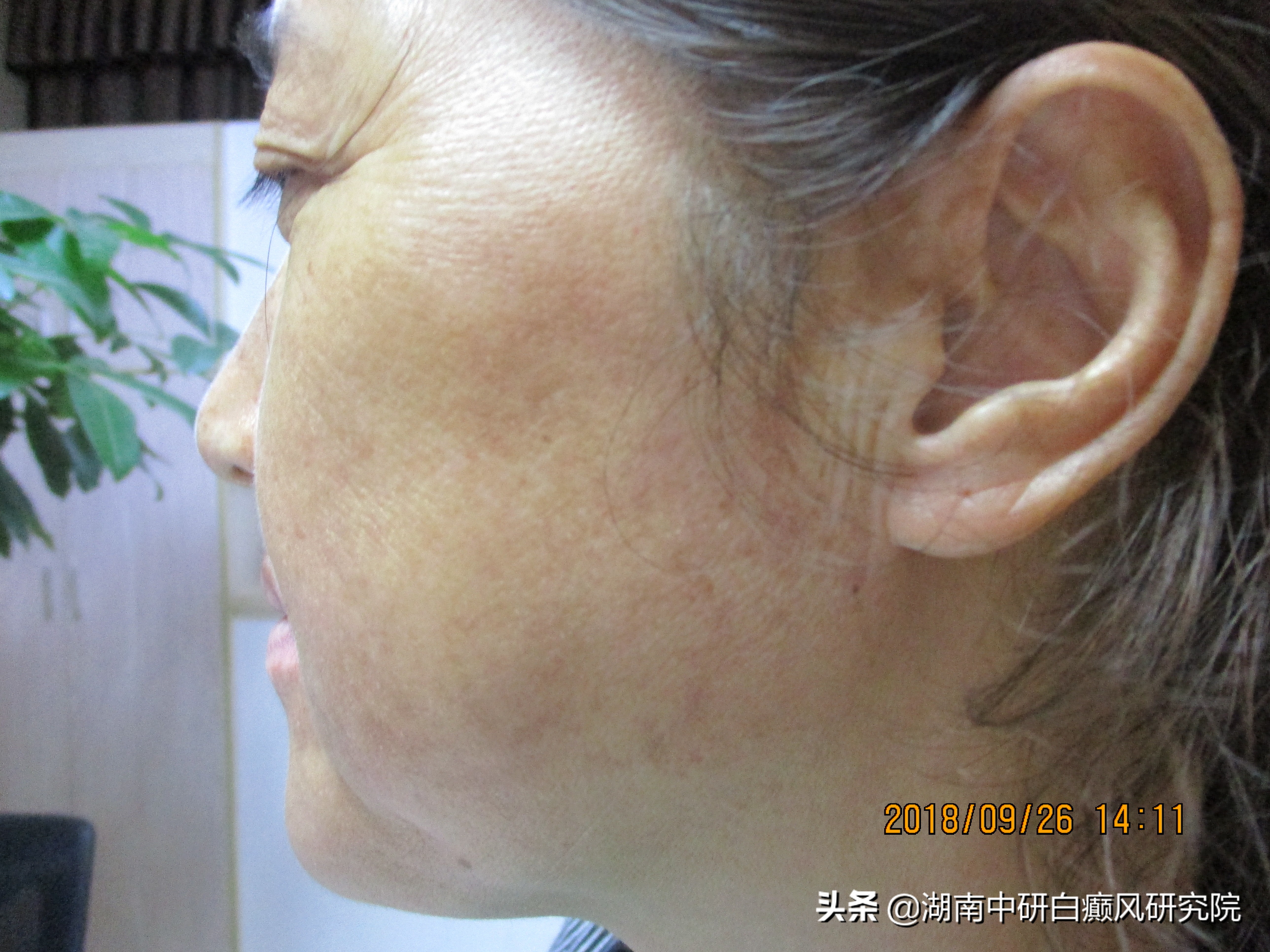 一位面部白癜风的患者，从患白到康复，她经历了什么？