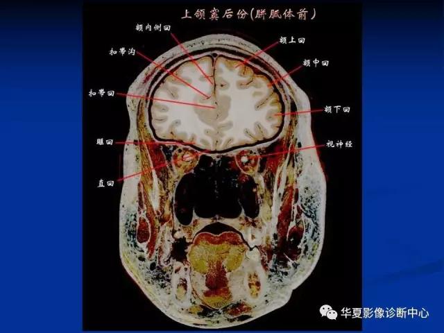 mra头颅解剖学详细讲解视频,常见的头颅mri图像