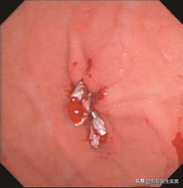 切息肉需要停阿司匹林吗,服用阿司匹林不能手术吗