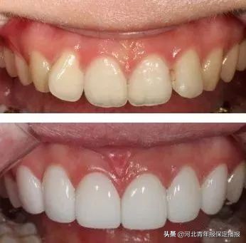 广大口腔公益种牙补贴,领取口腔优惠