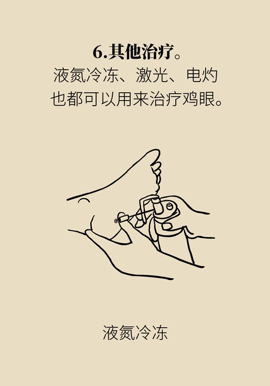 长了鸡眼该怎么办四大妙招教给你,长了鸡眼怎么治疗好得快