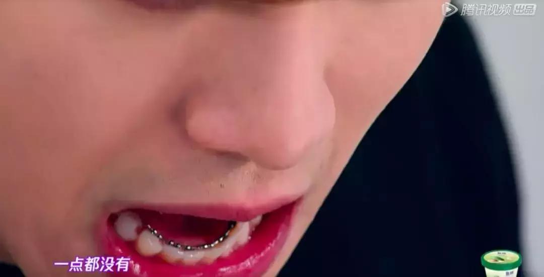 找了3个大学妹子聊聊:为什么在最美好的年纪戴牙套