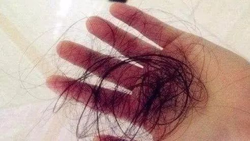 脾虚导致前额脱发,头顶脱发与脾虚有关系吗