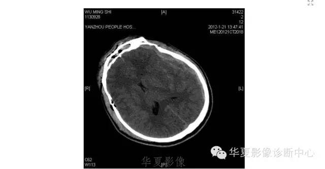 一文读懂颅内胆脂瘤,一文看懂背后的真相
