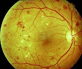 孕妇视力模糊怎么回事,孕妇视力下降的原因与护眼措施