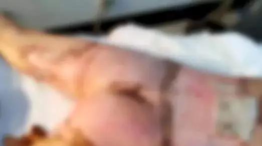 孩子被妈妈疏忽给烫伤,一岁女童掉进开水锅被烫伤