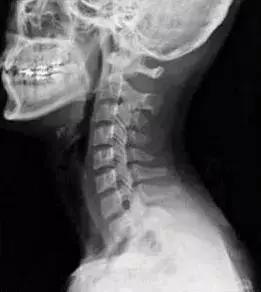 颈椎包夺命包富贵包,颈椎富贵包怎么解决