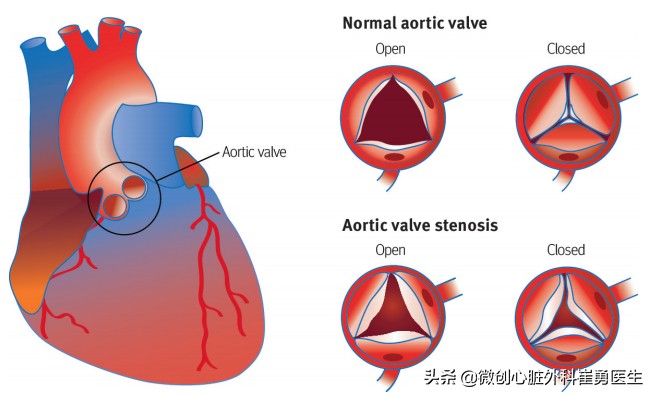 老人心脏换瓣建议机械还是生物,老人换人工瓣膜