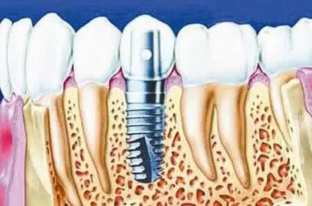 缺了一颗牙不影响吃饭,缺了一颗牙不补