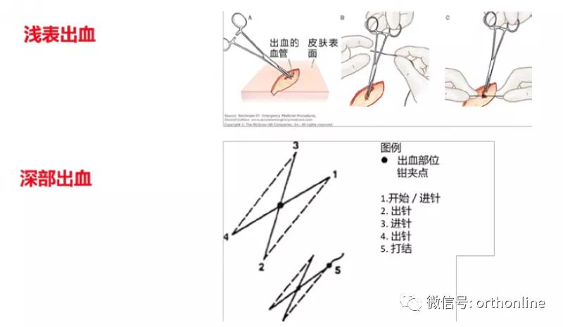 临床清创原则,临床清创