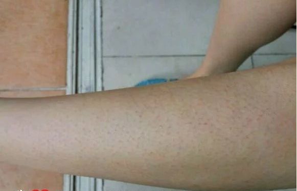 “鸡皮”仙女看过来！教你几招轻松去“鸡皮”