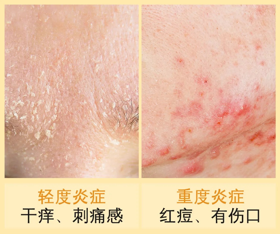 敏感长痘红痒该怎么办,红痘痒痛