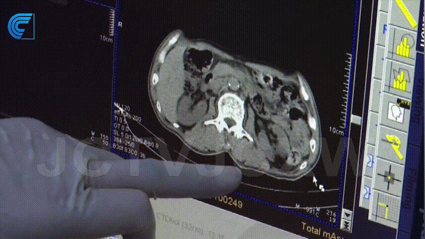 囊肿的硬化治疗技术可靠不,交城县人民医院