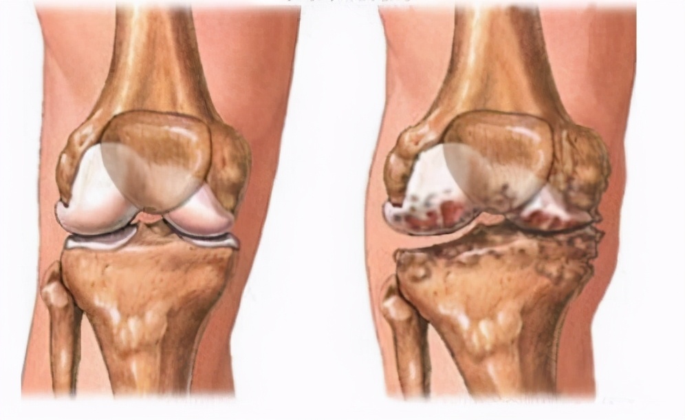 骨关节炎用什么理疗好,骨关节炎用啥药