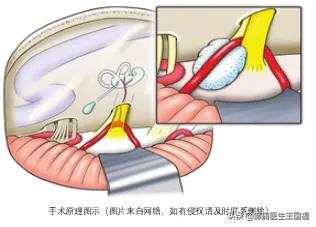 面肌痉挛打肉毒素能根治吗,面肌痉挛打肉毒素可以治愈吗