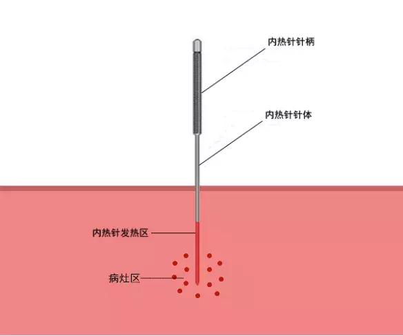 最有效的镇痛药,镇痛效果最强的镇痛药