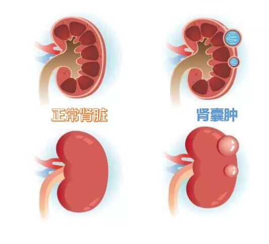 体检发现肾囊肿怎么办？医生告诉你最佳的应对方法