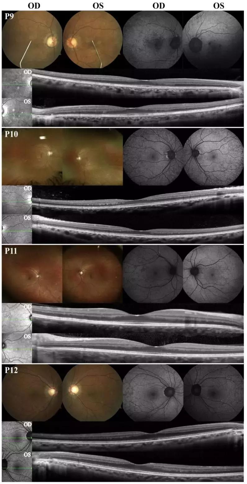 无脉络膜患者,无脉络膜症是怎样致盲