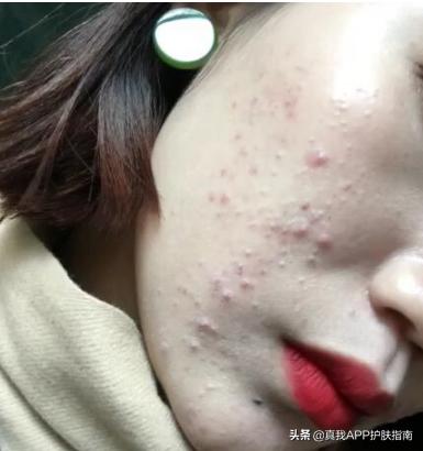 好用见效快的祛痘产品推荐,最好用的祛痘产品是什么