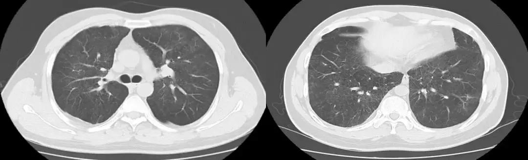 青年男性肺炎过后一直咳嗽怎么办,潜伏结核感染咳嗽咳痰