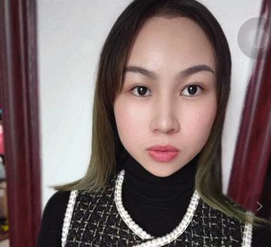 单眼皮凸嘴素人改造,肿眼泡整容成功案例