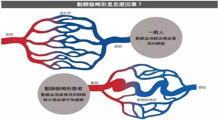 小脑血管畸形可以保守治疗吗,脑血管畸形出血保守治疗方法