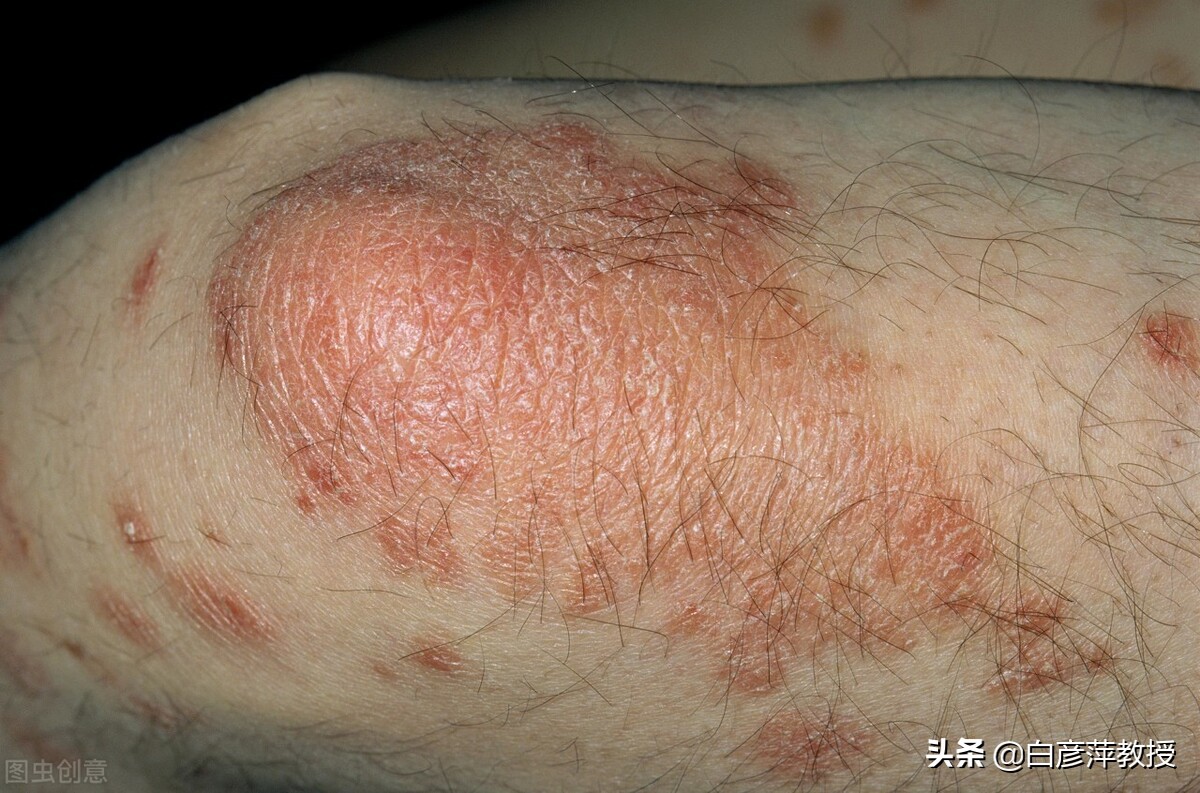 牛皮癣为什么春天更容易复发,牛皮癣难治吗