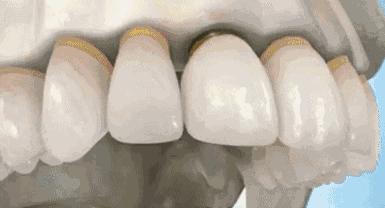 智齿蛀牙痛有什么有效方法止痛,智齿旁边牙松动蛀牙如何处理