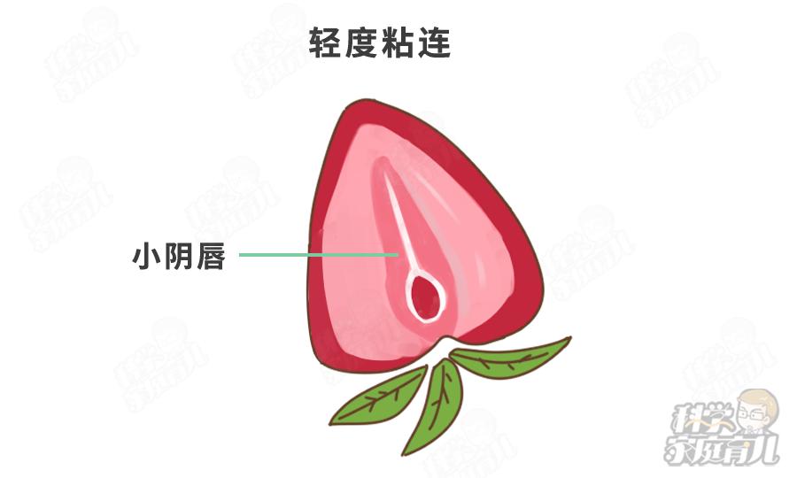 错不起!娃阴唇粘连,一碰就哭,到了这种程度,必须处理