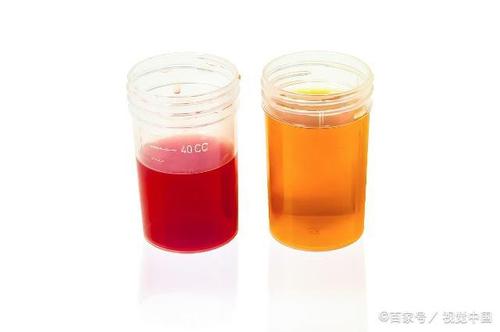 体检“尿潜（隐）血阳性”不等于“血尿”