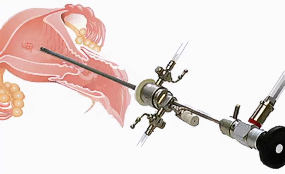 试管前做宫腔镜检查有利于着床吗,试管必做的检查