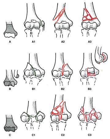 肱骨髁上骨折使用什么钢板,肱骨近端骨折保守治疗会粘连吗