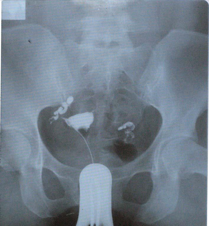 做试管婴儿要割掉输卵管么,试管婴儿要切除输卵管吗