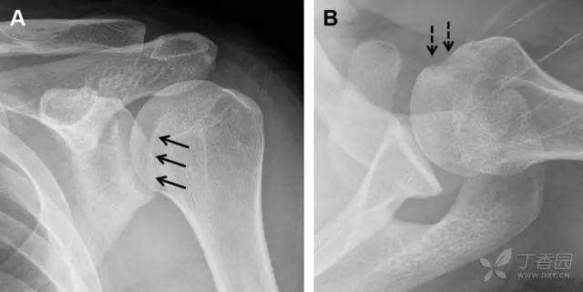 常见的八种骨折,容易漏诊的肩关节骨折