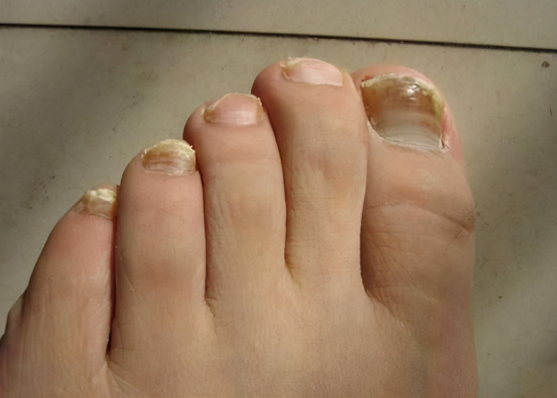 脚指甲变厚变黄空心是灰指甲吗,指甲变厚是灰指甲的前兆