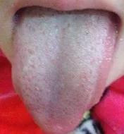 舌头中间有裂纹边有齿痕怎么回事,舌头中间有裂纹边缘锯齿怎么回事