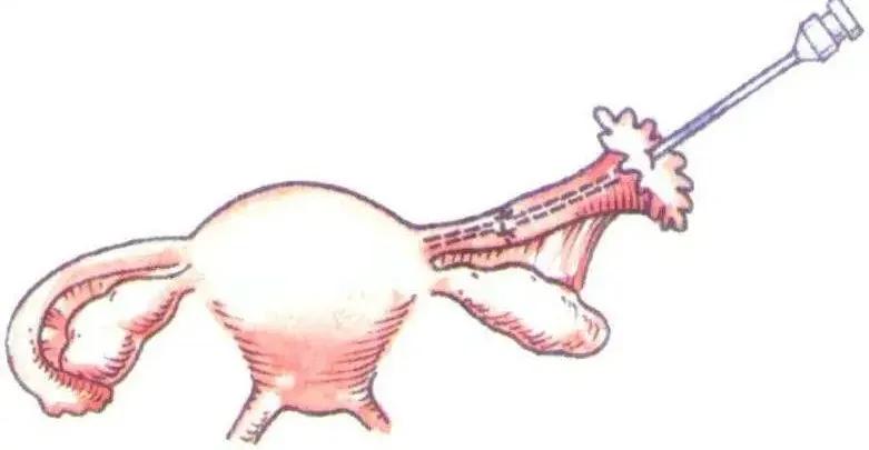 输卵管复通失败可以再复通吗,输卵管复通是什么意思