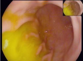 功能性消化不良和胃食管反流用药,胃食管反流怎么联合用药