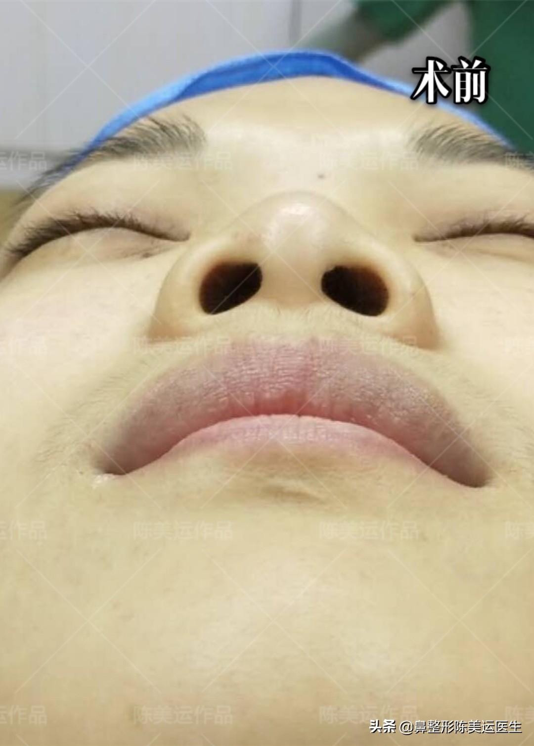 塌鼻子怎么能变成尖鼻子,鼻子太窄太小是不是很难增高鼻梁