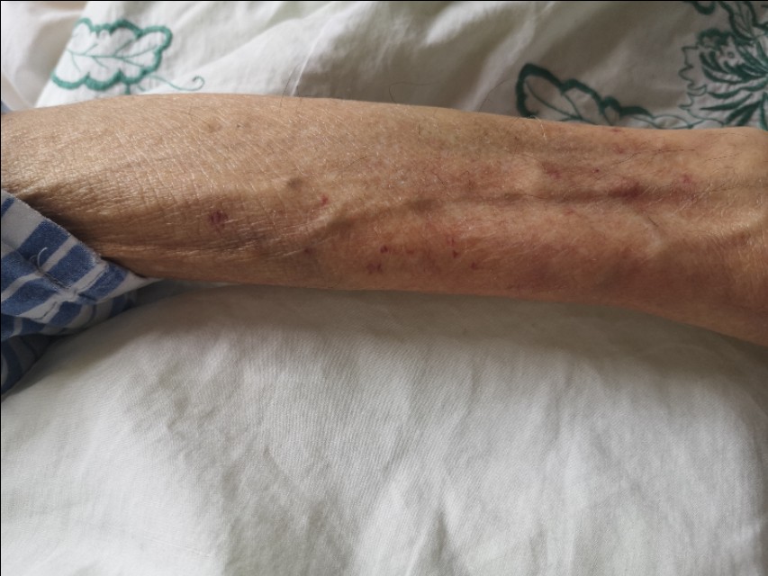 中西医结合治疗原因不明肠梗阻、腹水转氨酶明显升高病案一例！