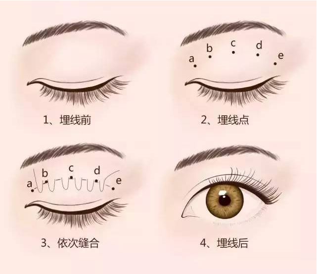 戚薇双眼皮修复视频完整版,戚薇肉条双眼皮是如何恢复的