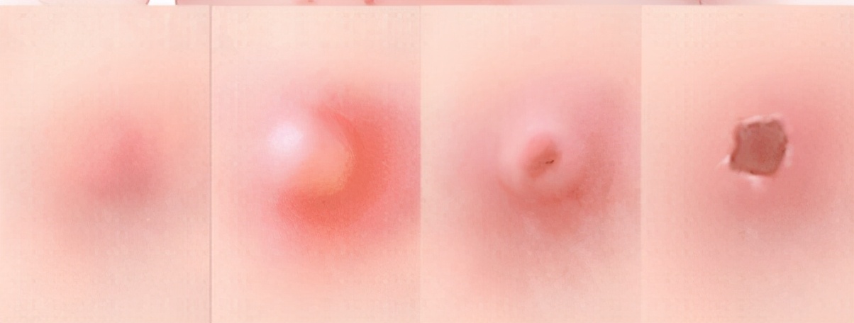 一颗水痘的独白|又是一年战“痘”季，快来看看对手什么样